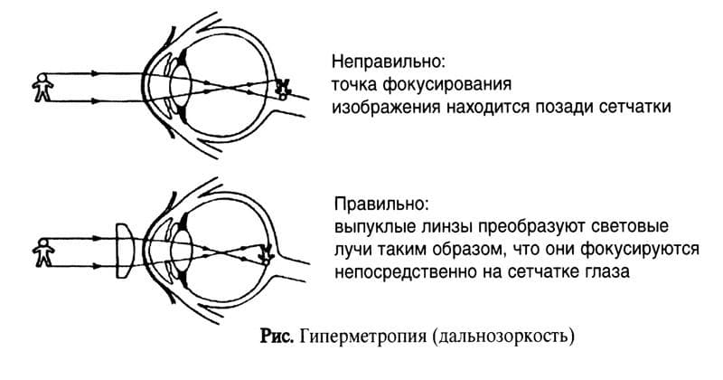 Гиперметропия средней степени что это такое, у детей, слабой, обоих глаз, высокой, код мкб 10