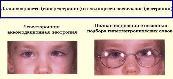 дальнозоркость и косоглазие