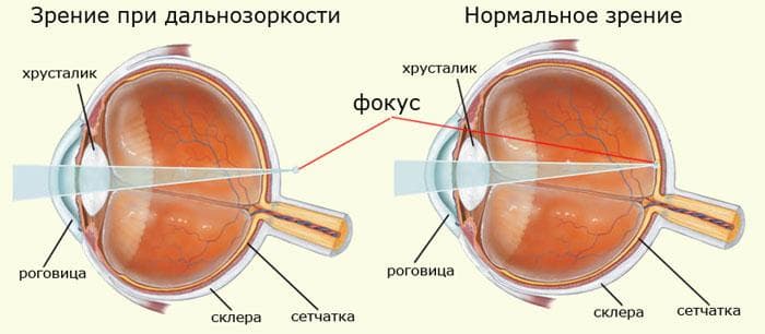 дальнозоркость или гиперметропия