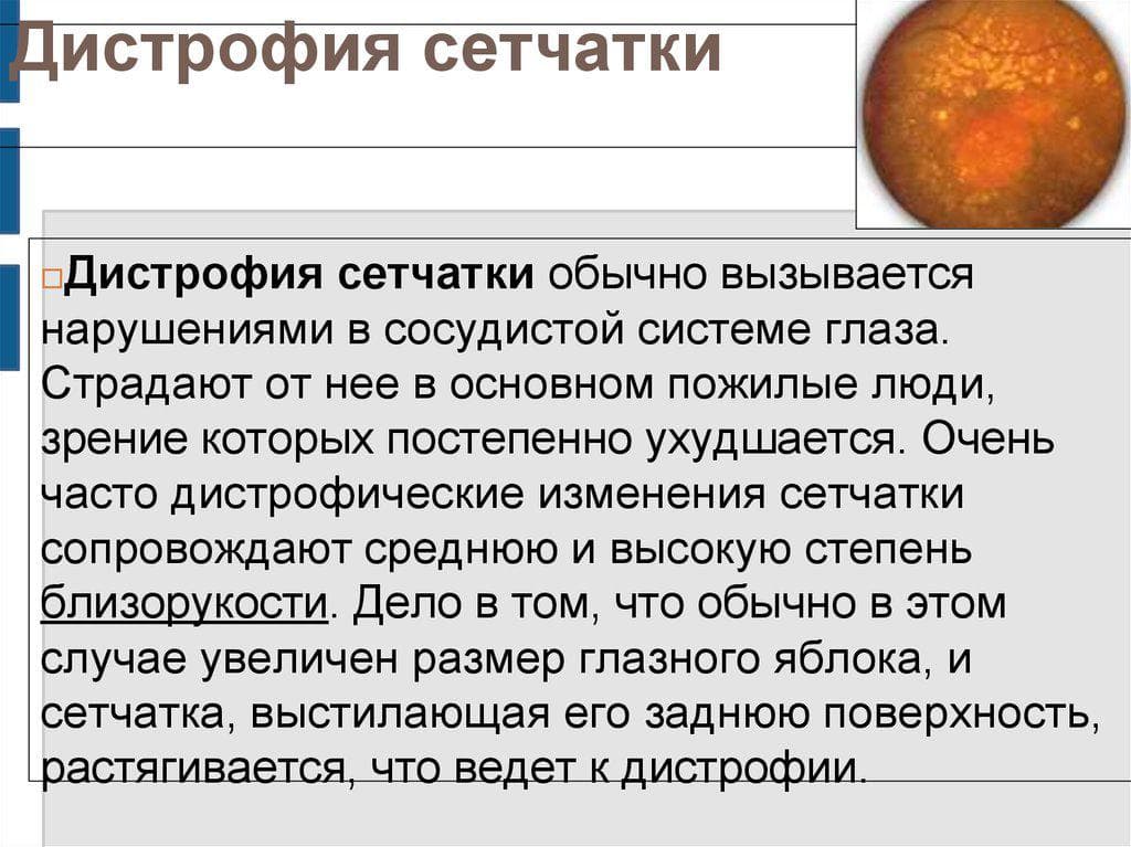 distrofiya-setchatki