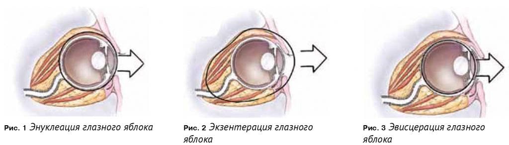 ekzenteraciya1