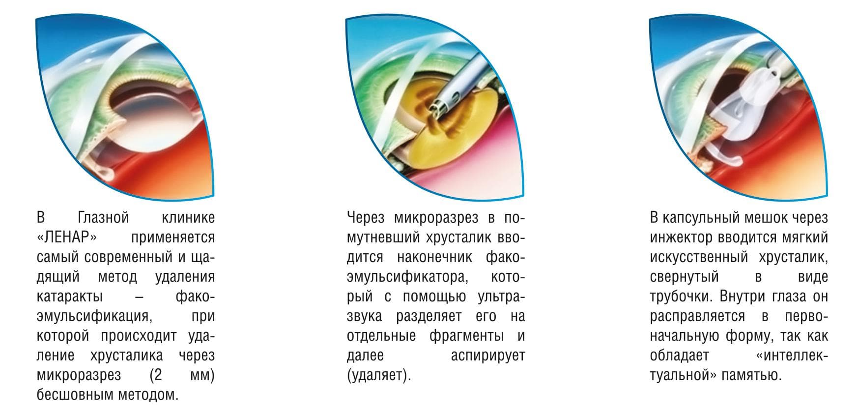Катаракта: операция, реабилитация после, лечение и профилактика, какие работы запрещены, по удалению