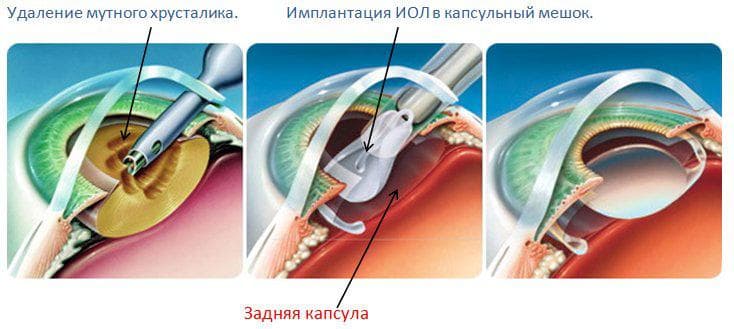 факоэмульсификация