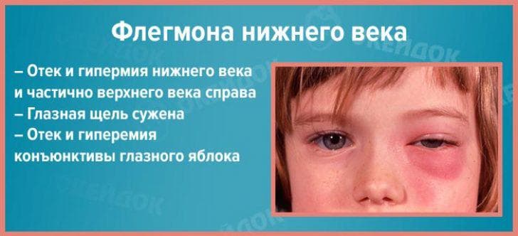 flegmonu-veka