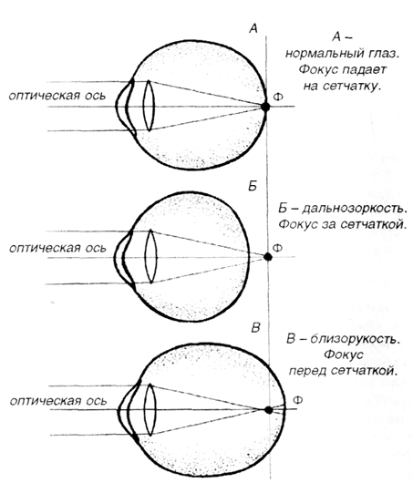 фокус при дальнозоркости