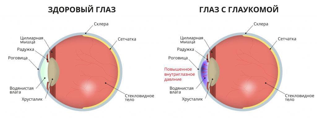 glaukoma