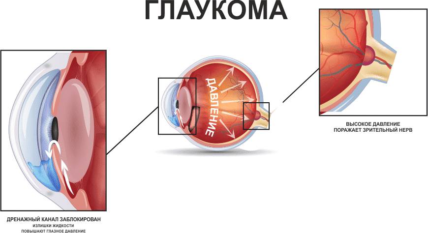 глаукома