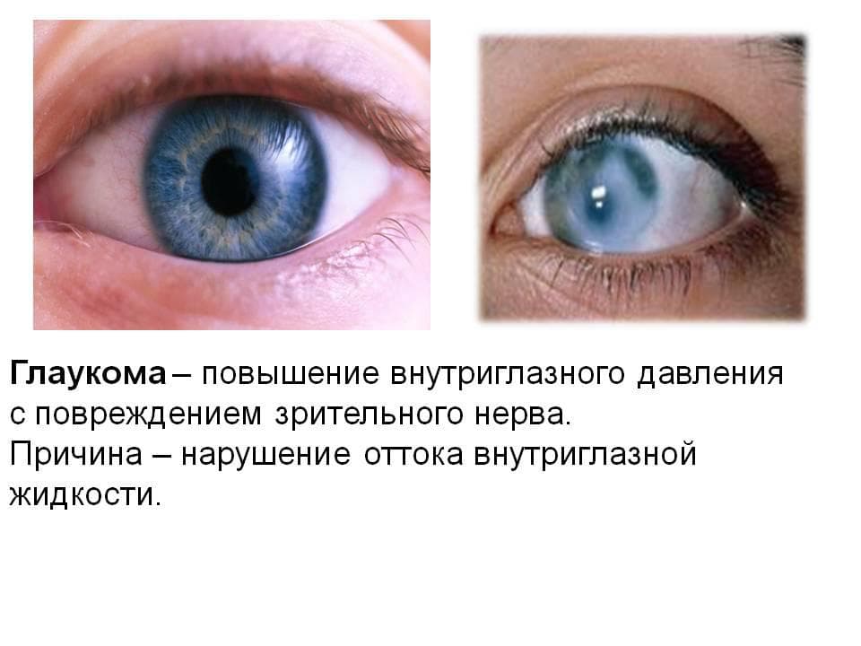 glaukoma