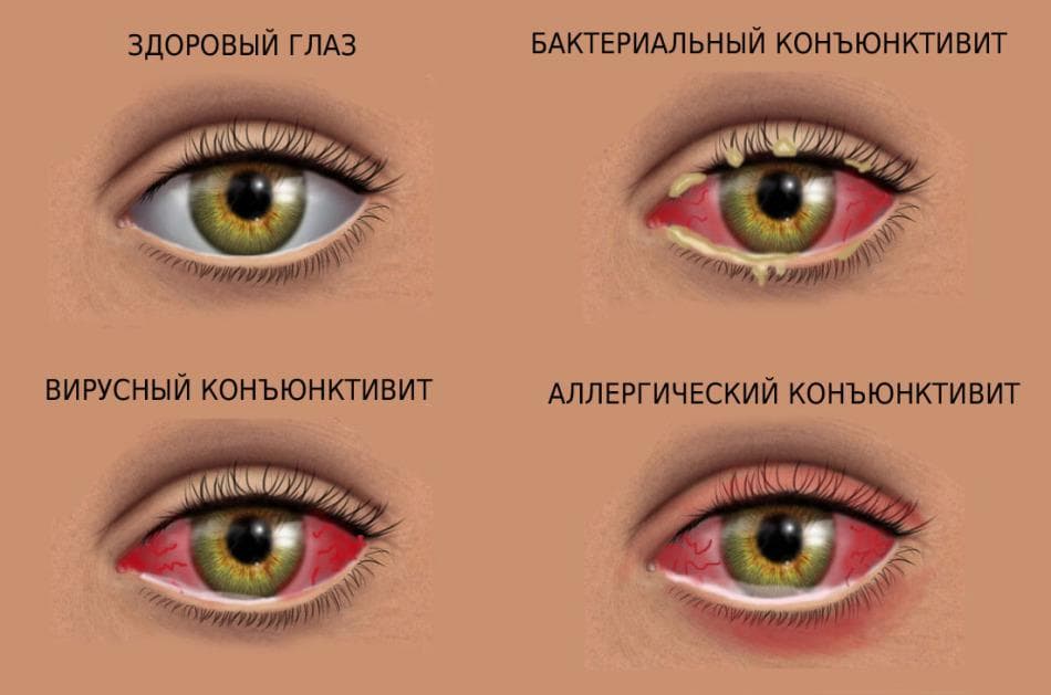 gnoyatsya-glaza-u-rebenka-lechenie-narodnimi-sredstvami