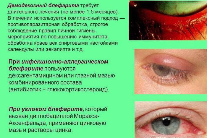хронический блефарит