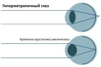 Гиперметропия средней степени что это такое, у детей, слабой, обоих глаз, высокой, код мкб 10