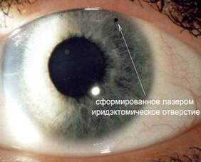 глаукома