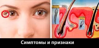 демодекоз век