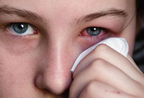 istock_photo_of_woman_holding_tissue_to_reddened_eye