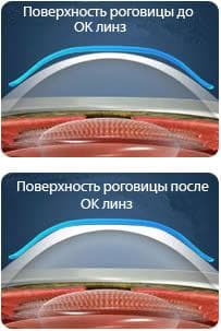как работает ортокератология