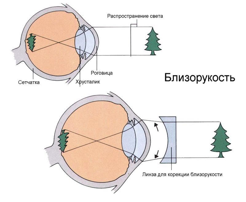 как видит человек при близорукости