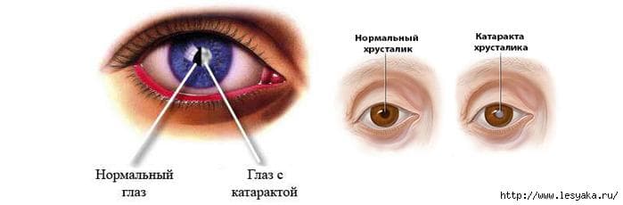 kak-vyglyadit-glaz-s-kataraktoj