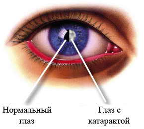 катаракта