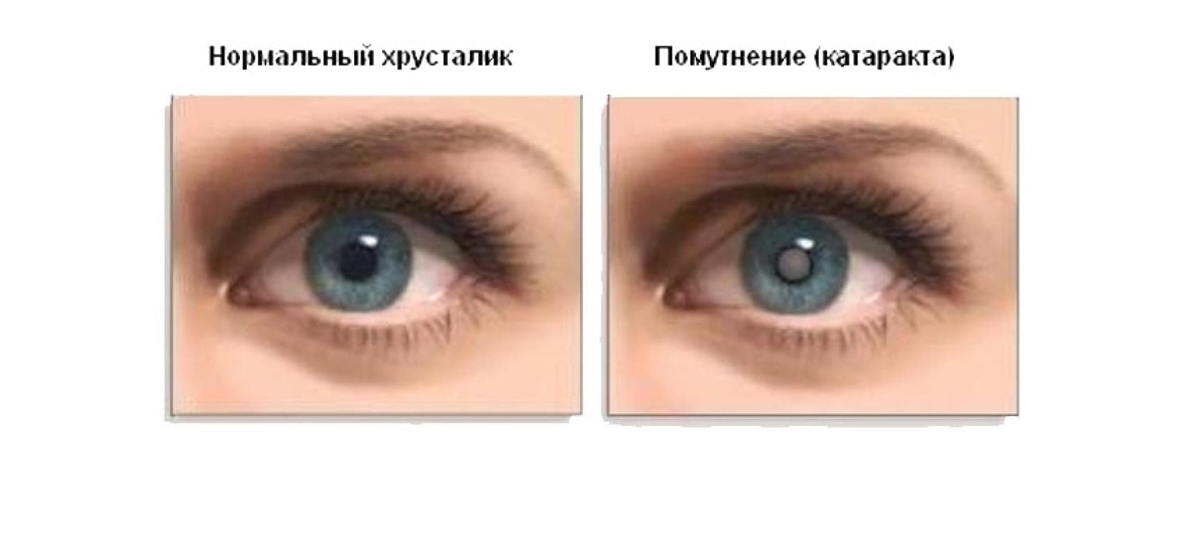катаракта