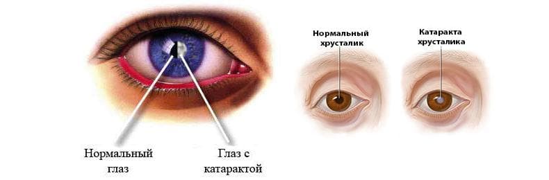 катаракта
