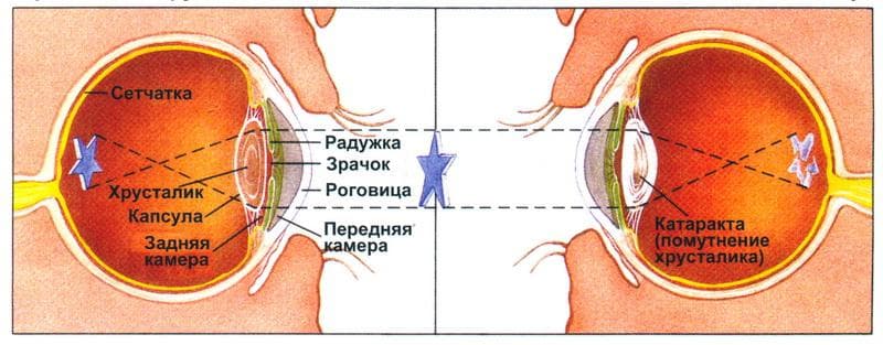 причины появления катаракты