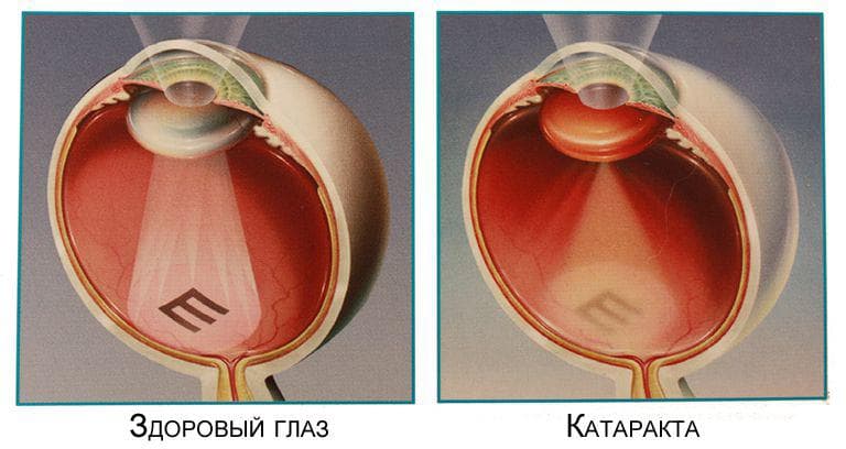 Признаки катаракта глаза, симптомы, операция по удалению, как лечить, без, первые, народными средствами, в ранней стадии, начальной
