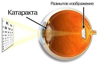 катаракта причины симптомы лечение