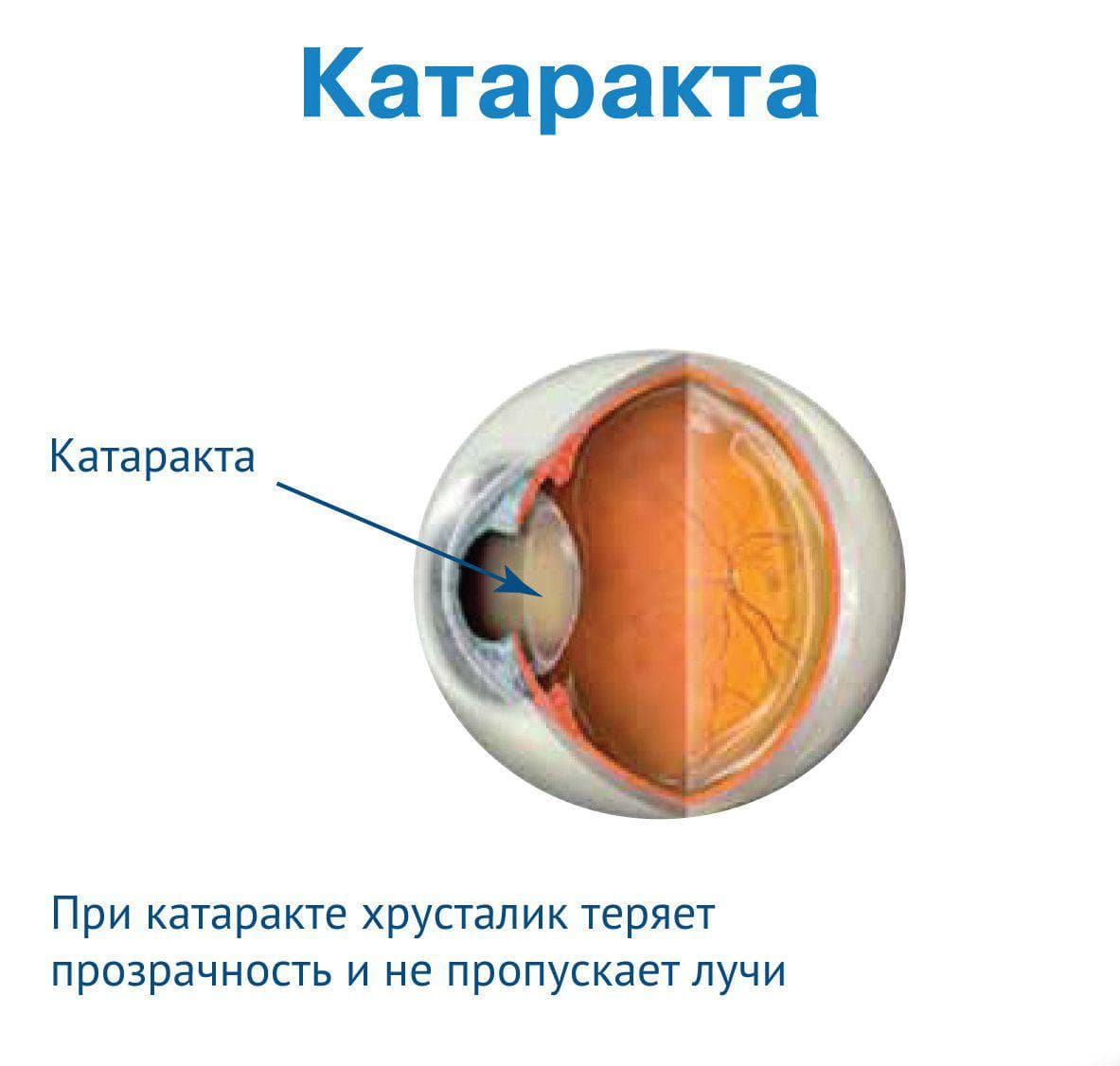 катаракта причины симптомы лечение и профилактика, катаракта лечение, лечение катаракты, катаракта лечение народными средствами без операции отзывы, лечение катаракты народными средствами, катаракта лечение народными средствами, катаракта лечение капли, лечение катаракты народными средствами отзывы вылечившихся,