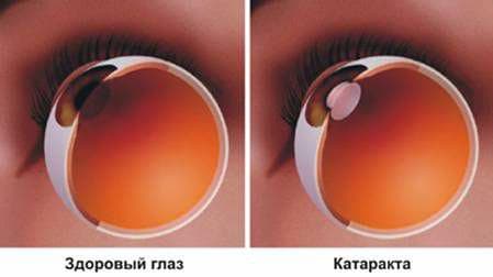 операция катаракта
