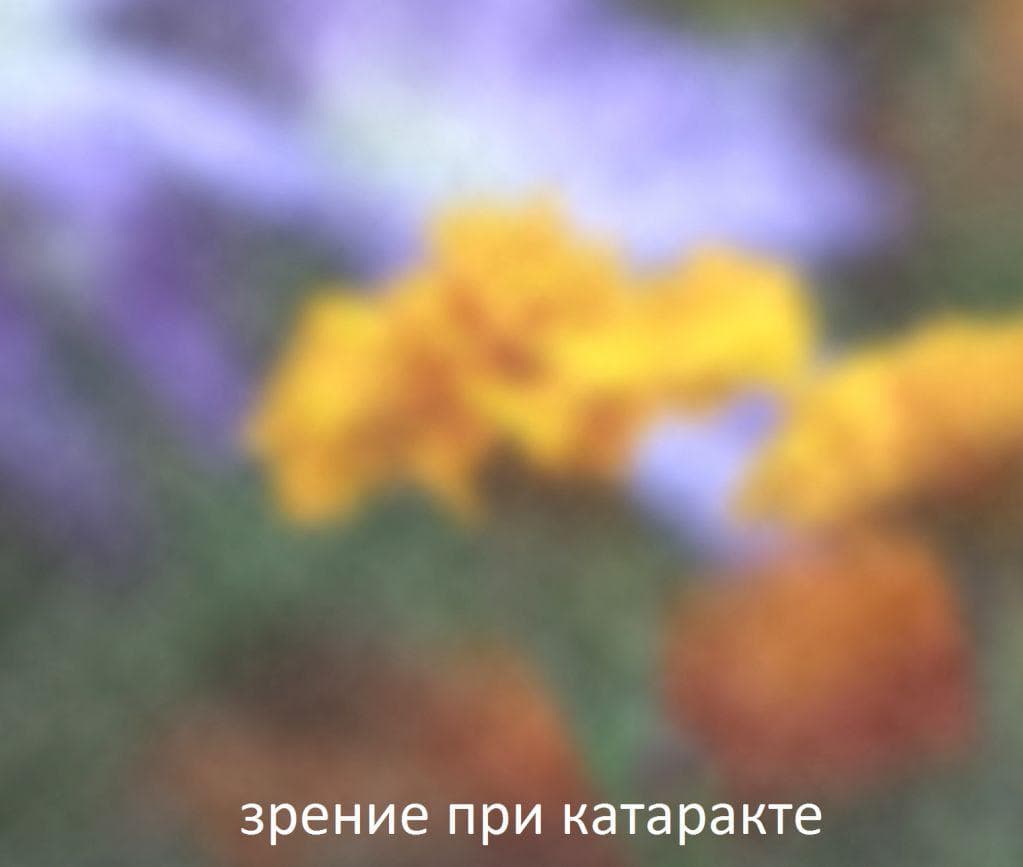 катаракта удаление, удаление катаракты, катаракта операция по удалению, операция по удалению катаракты, послеоперационная катаракта удаление катаракты послеоперационный, послеоперационный период после удаления катаракты, операция по удалению катаракты с заменой хрусталика,