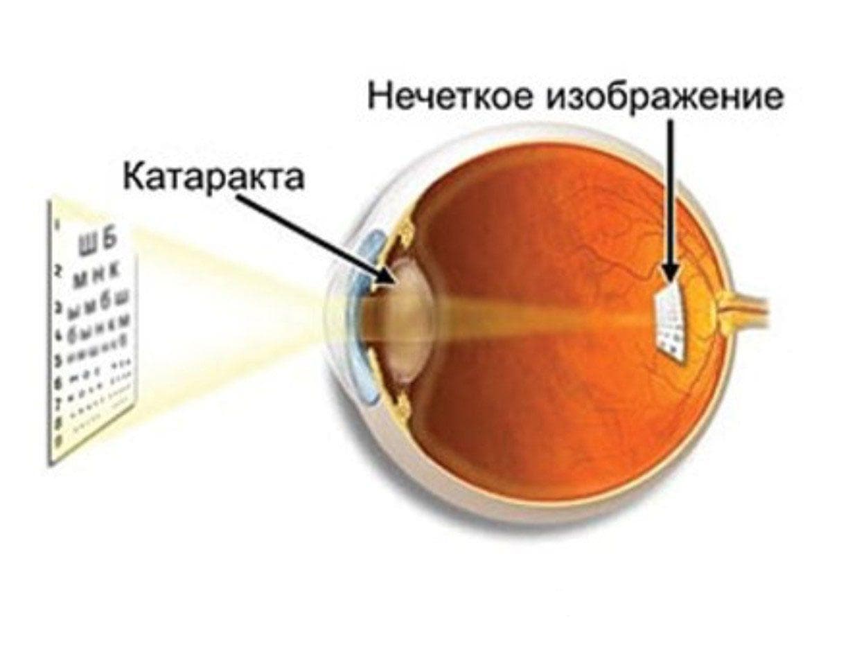 катаракта удаление, удаление катаракты, катаракта операция по удалению, операция по удалению катаракты, послеоперационная катаракта удаление катаракты послеоперационный, послеоперационный период после удаления катаракты, операция по удалению катаракты с заменой хрусталика,