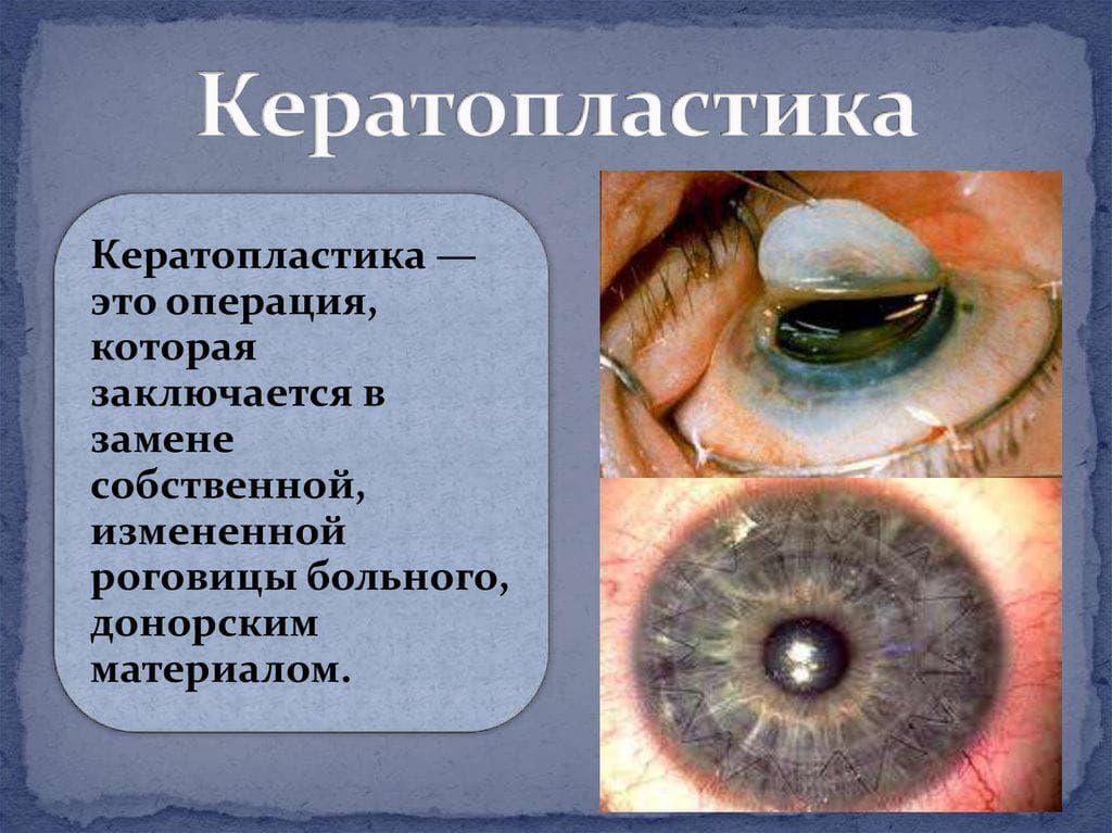 кератопластика 