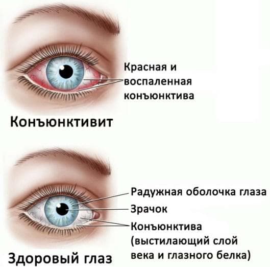Как быстро вылечить конъюнктивит: лечение, чем у детей, симптомы, аллергический, бактериальный, при беременности, в домашних условиях