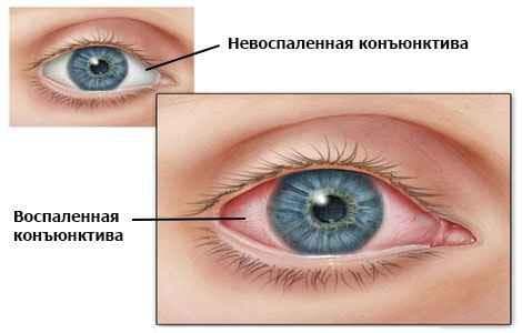 Как быстро вылечить конъюнктивит: лечение, чем у детей, симптомы, аллергический, бактериальный, при беременности, в домашних условиях
