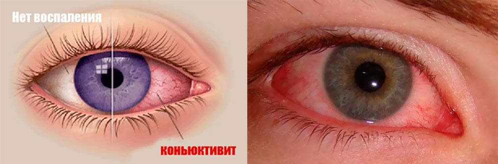 конъюнктивит у взрослых