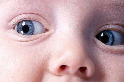 детский конъюнктивит фото, как долго лечить конъюнктивит у ребенка, как проявляется конъюнктивит у детей, хронический конъюнктивит у ребенка, конъюнктивит у двухмесячного ребенка, чем лечить конъюнктивит у детей 4 года, конъюнктивит у маленьких детей,