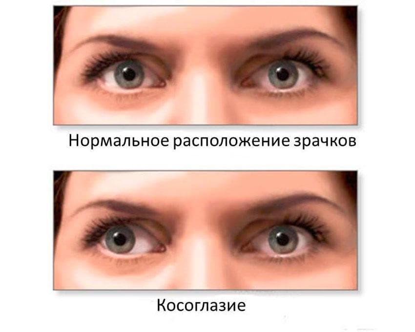 Косоглазие