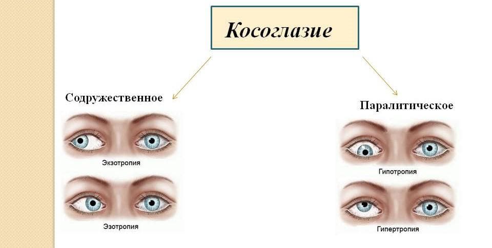 косоглазие