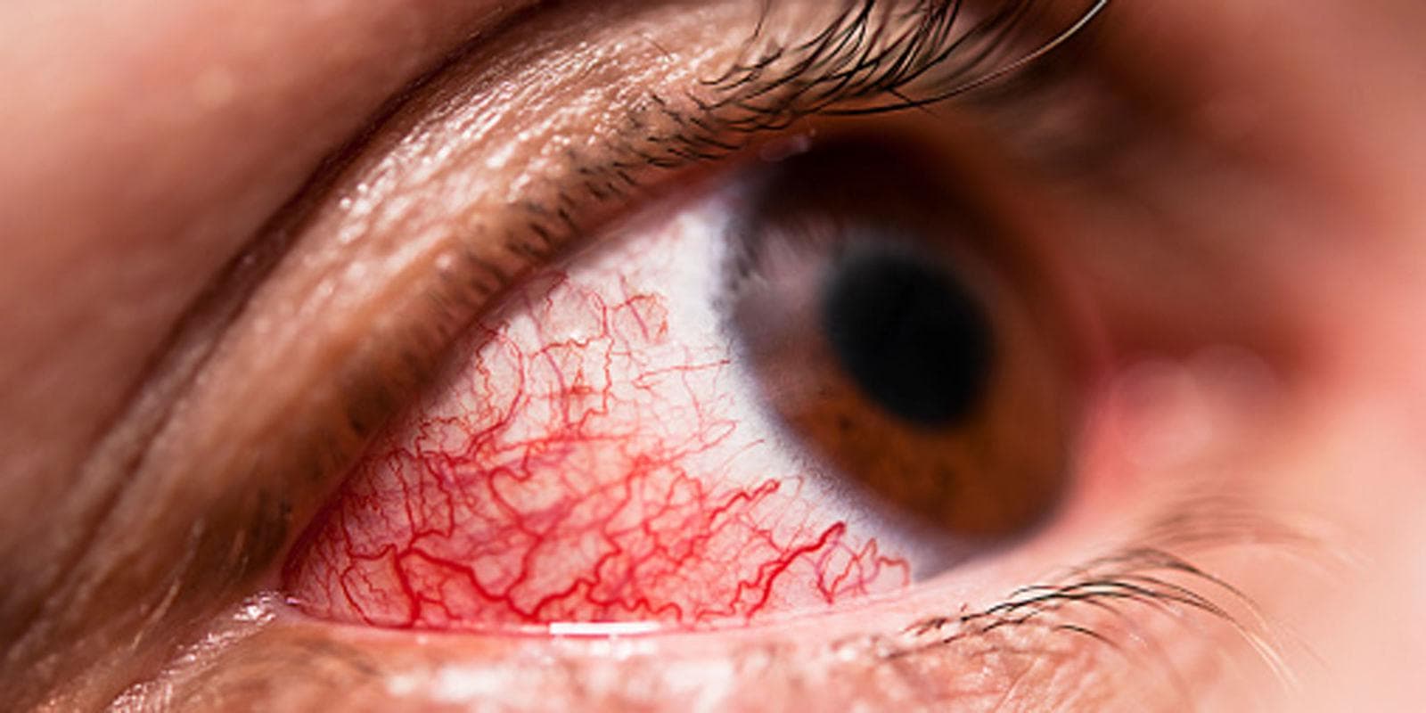 landscape-1445715811-conjunctivitis-175423329-1024x512