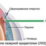 лазерная базальная иридэктомия