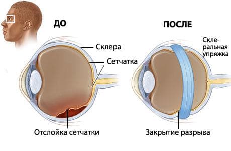 Лечение отслойки сетчатки глаза методом пломбирования