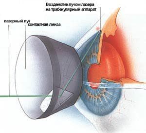 глаукома причины симптомы лечение и профилактика, глаукома симптомы, глаукома симптомы и лечение, признаки глаукомы глаза симптомы, глаукома причины симптомы лечение и профилактика фото, признаки глаукомы на ранних стадиях, симптомы глаукомы на ранних стадиях, открытоугольная глаукома причины симптомы лечение и профилактика, симптомы катаракты и глаукомы закрытоугольная глаукома симптомы