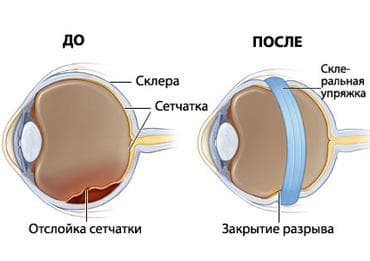 лечение отслоения сетчатки