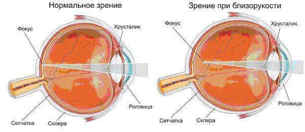 мультифокальные линзы что это такое, мультифокальные контактные линзы, торическая интраокулярная линза, мультифокальные однодневные контактные линзы, мультифокальные контактные линзы clariti multifocal, мультифокальные линзы ежедневной замены,