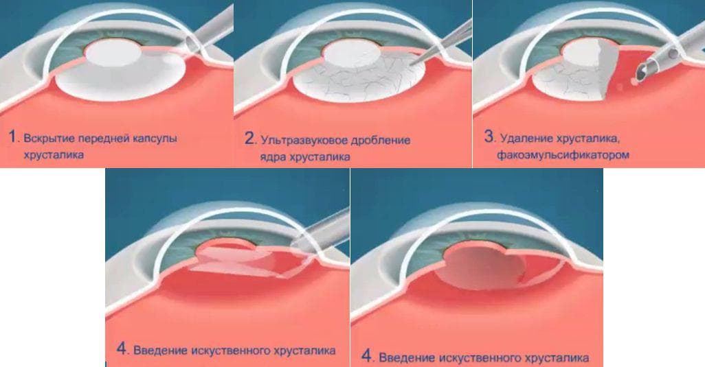 мультифокальные линзы что это такое, мультифокальные контактные линзы, торическая интраокулярная линза, мультифокальные однодневные контактные линзы, мультифокальные контактные линзы clariti multifocal, мультифокальные линзы ежедневной замены,