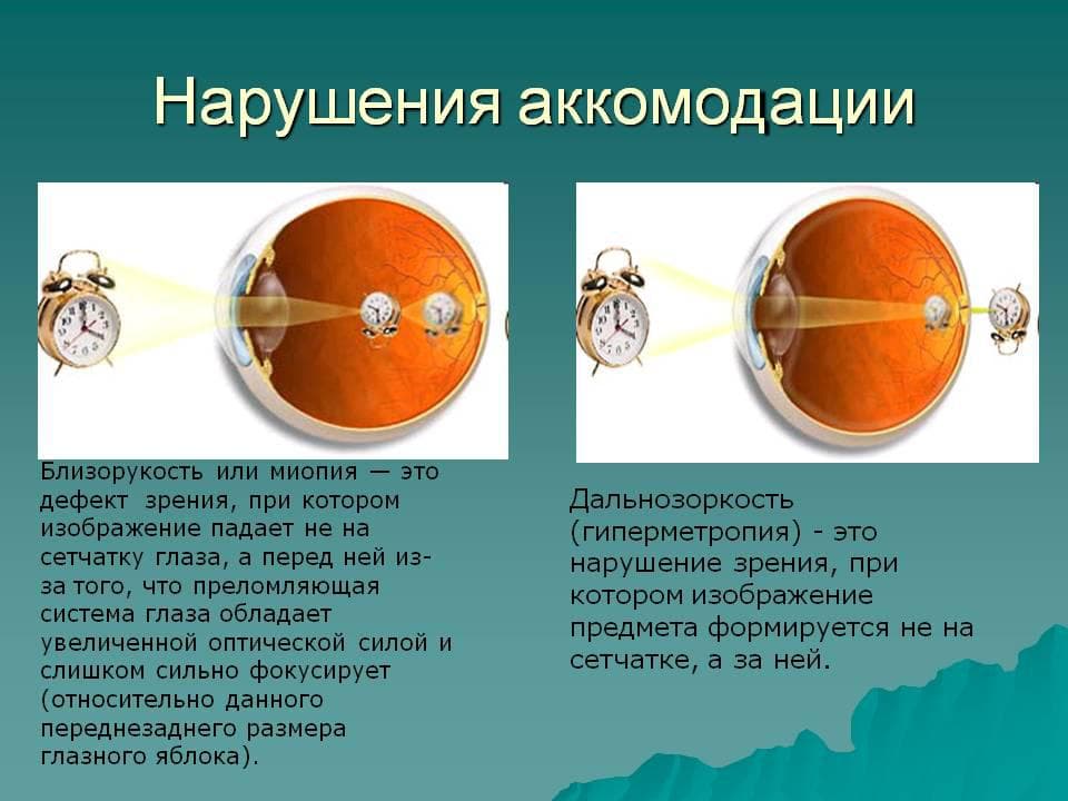 нарушение аккомодации