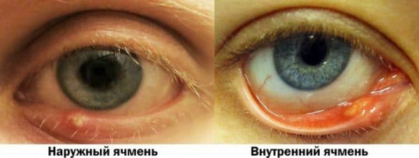 naruzhnyj-vnutrennij-yachmen-768x290