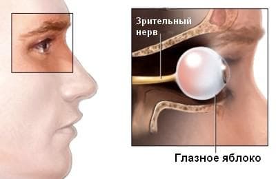 неврит зрительного нерва