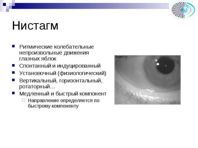 nistagm
