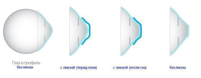 ночные линзы, ночные линзы для восстановления зрения, ночные линзы для восстановления зрения отзывы врачей, ночные линзы вред, ночная среда обитания для линз, ночные линзы цена, уход за ночными линзами, ночные контактные линзы, ночные линзы подобрать,